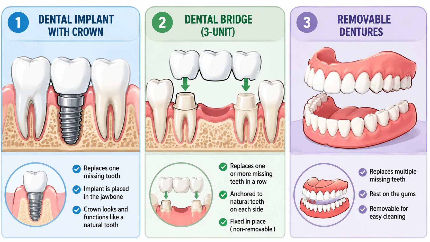 An infographic comparing dental implants, 3-unit dental bridges, and removable dentures for replacing missing teeth.