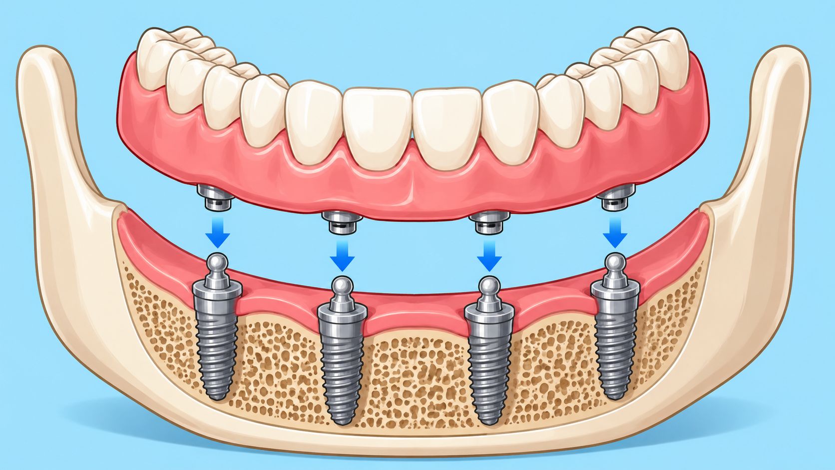 A 3D illustration showing a removable implant-supported denture snapping onto four titanium dental implants in the jaw.