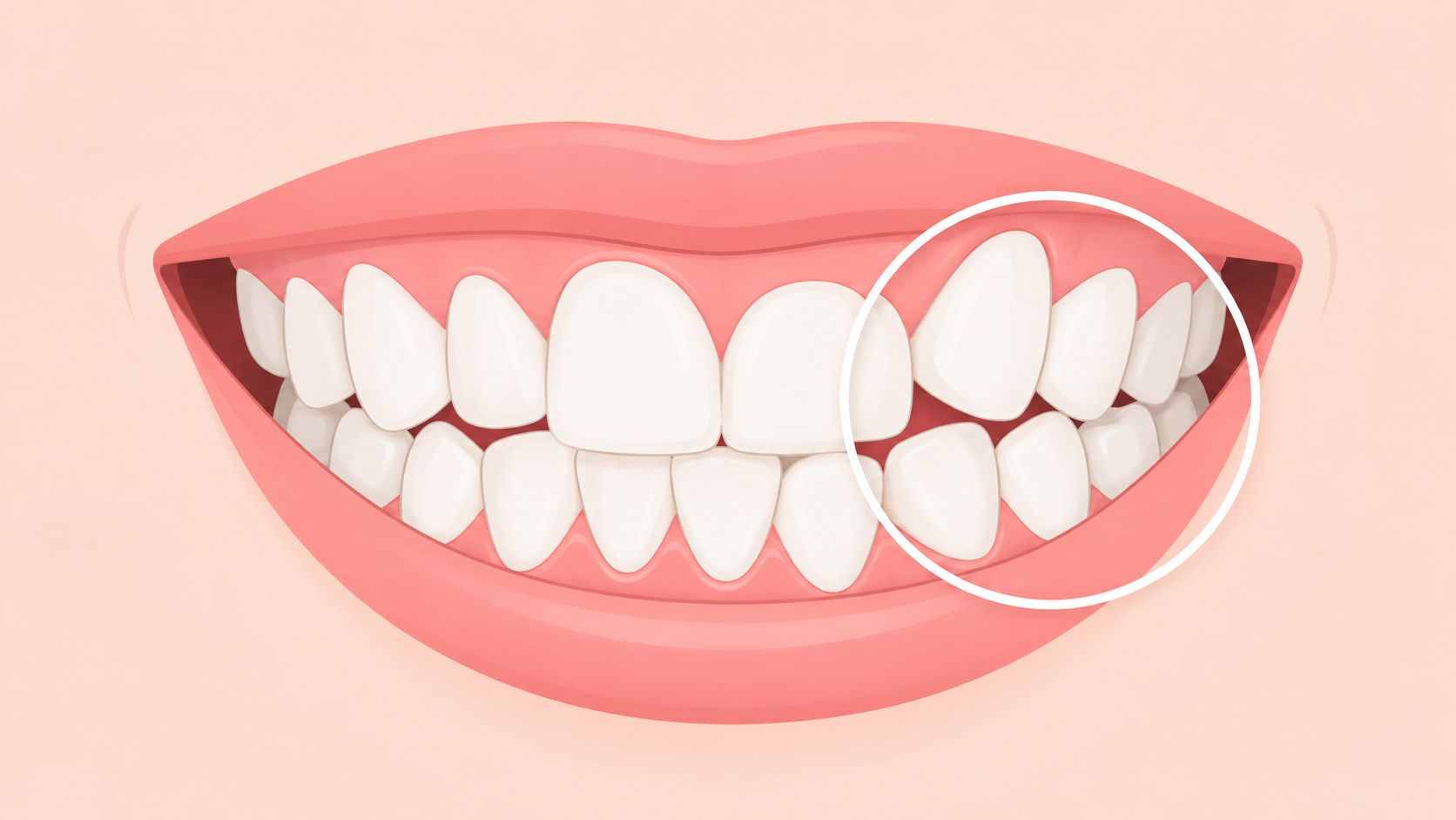 A close-up illustration of a smile showing dental misalignment, specifically focusing on crowded upper teeth.