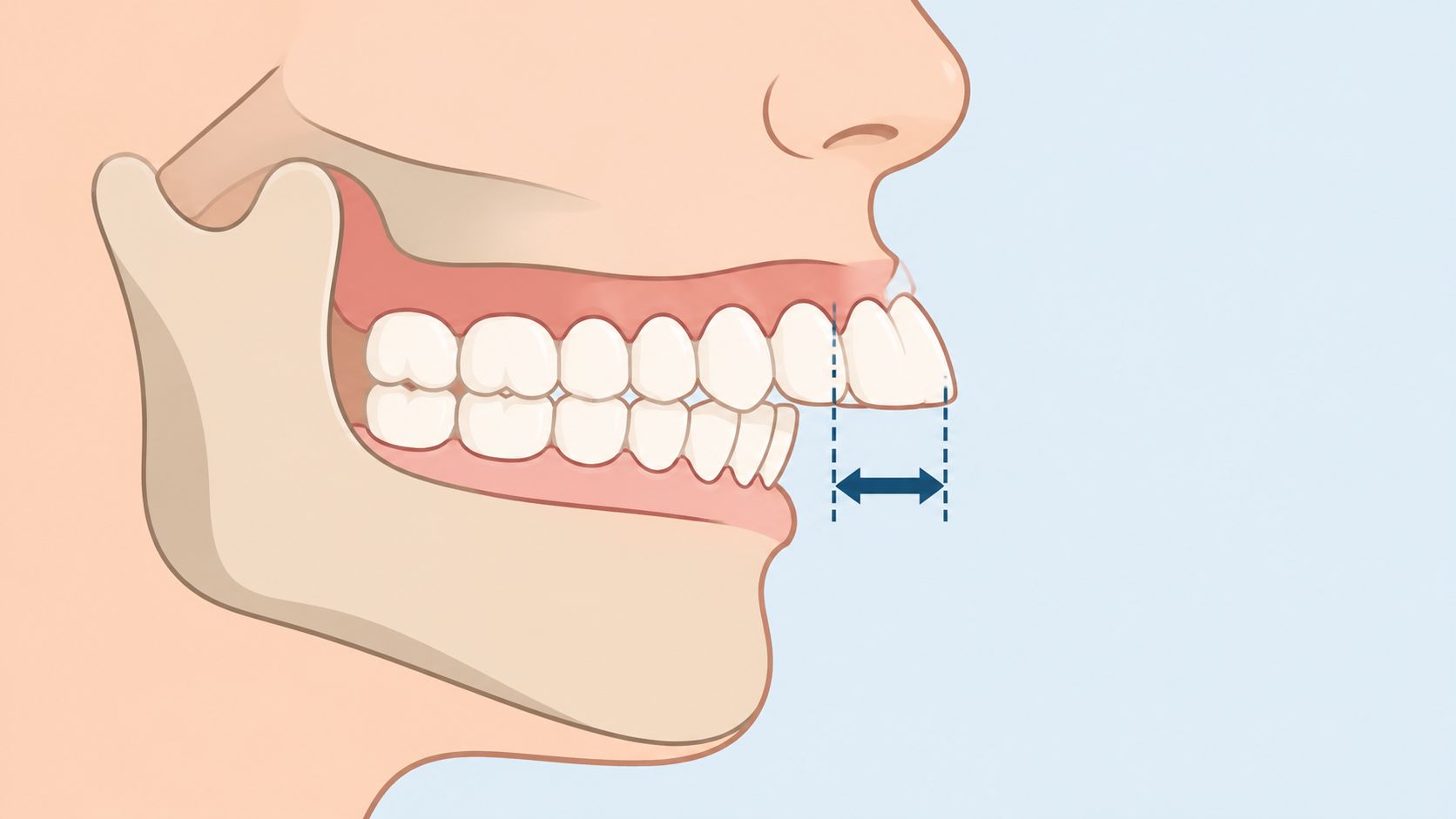 A side-view illustration of a human mouth showing an overbite with an arrow indicating the horizontal gap.