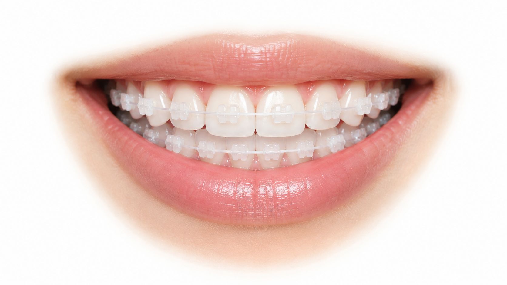 A close-up shot of a person smiling brightly, revealing clean, straight teeth with clear ceramic dental braces.