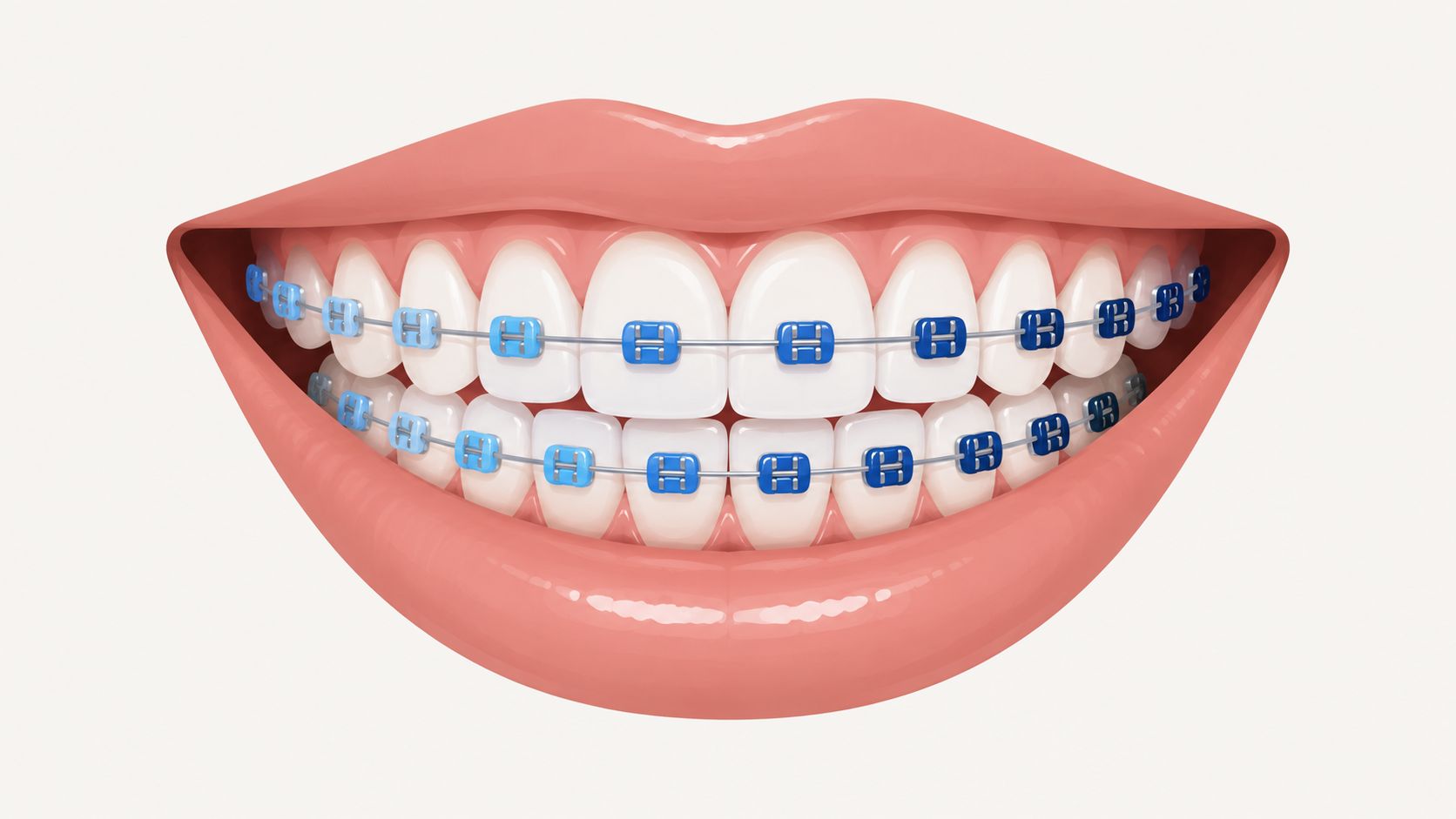 A close-up view of a smile showing human teeth with metal braces and colorful blue bands.