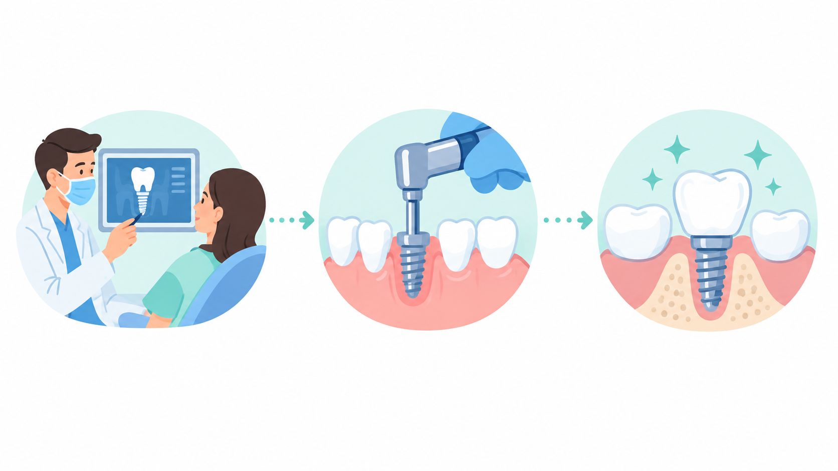A dental illustration showing the step-by-step process of getting dental implants from consultation to final placement.