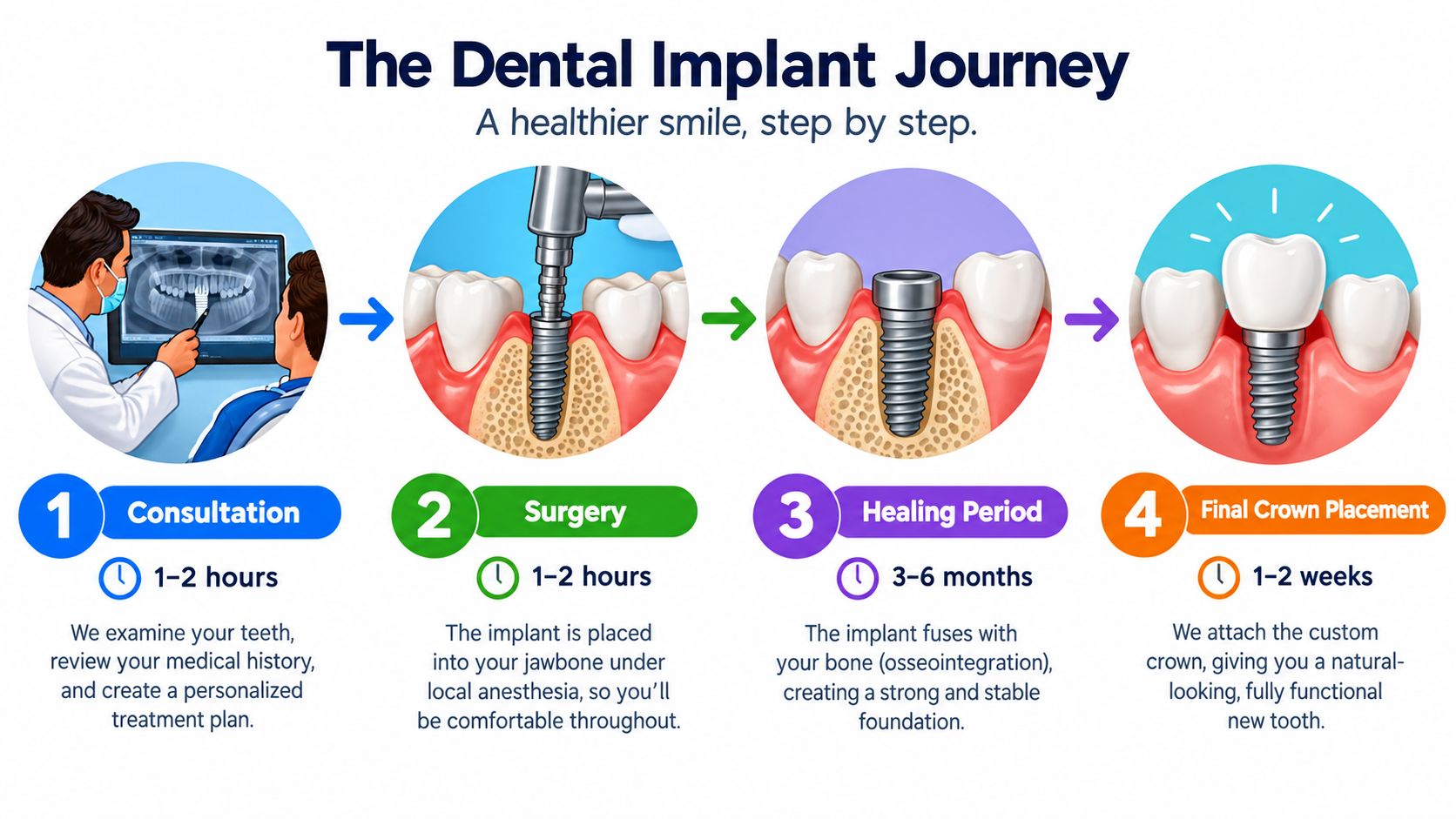 A four-step infographic illustrating the dental implant journey from consultation and surgery to healing and crown placement.