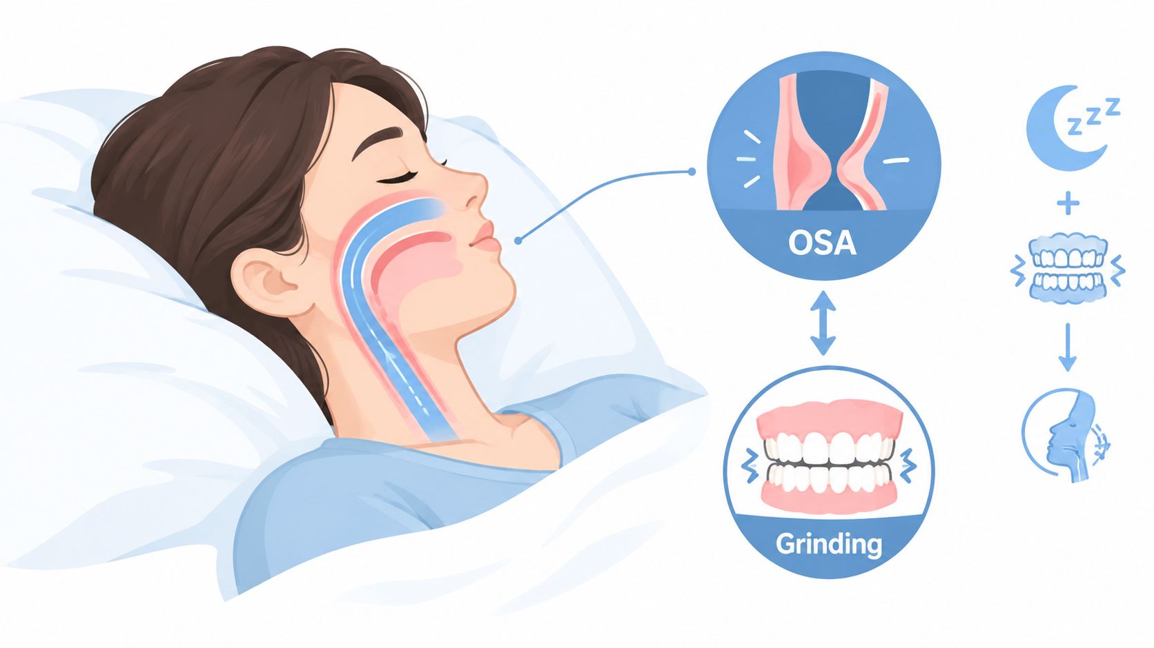A diagram illustrating the connection between obstructive sleep apnea and nocturnal teeth grinding in a sleeping person.