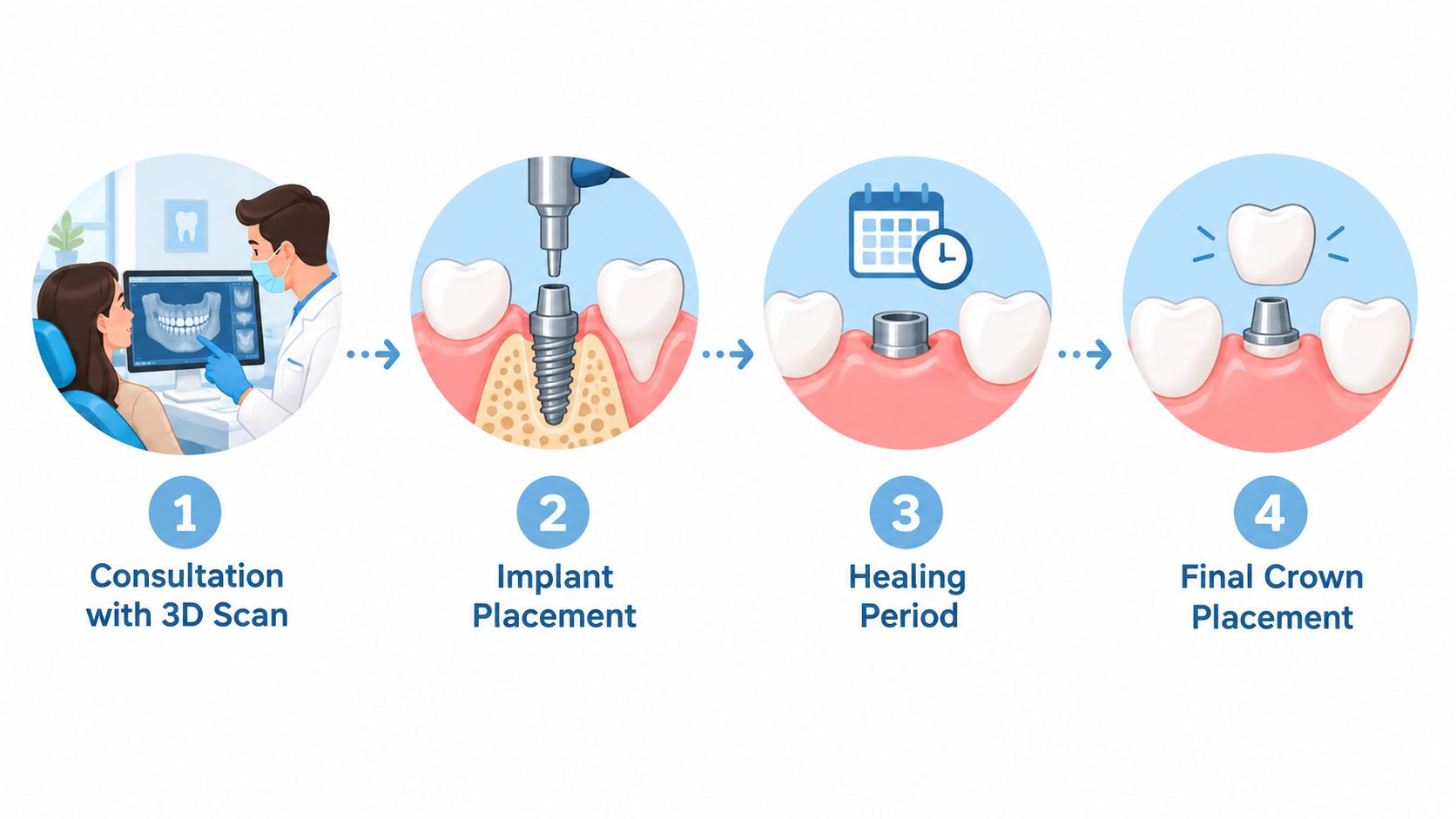 A four-step dental illustration showing the stages of a tooth implant procedure from consultation to crown placement.