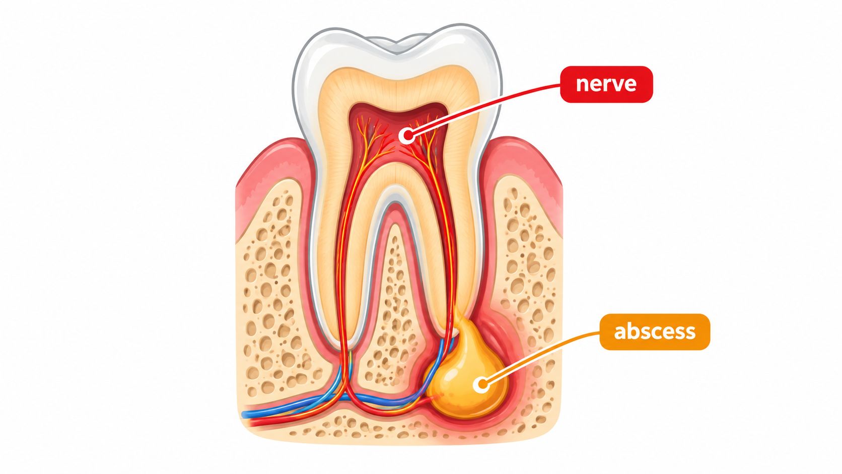 A cross-section illustration of a tooth showing a dental abscess at the root and inflamed nerve.