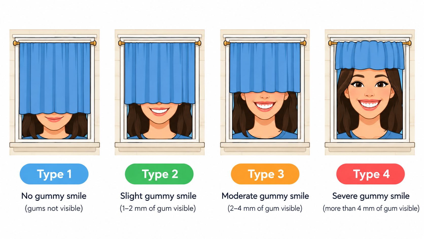 An infographic illustrating four types of gummy smile classifications ranging from no gum to severe gum visibility.