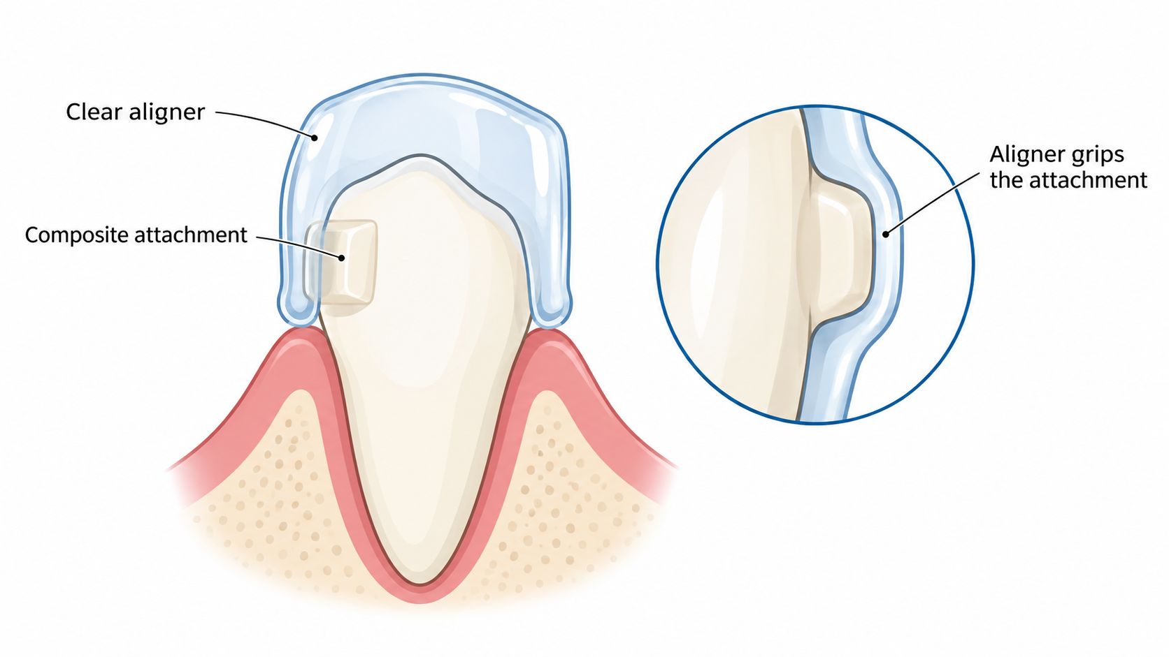 A diagram showing how a clear aligner tray fits over a tooth with a composite attachment.